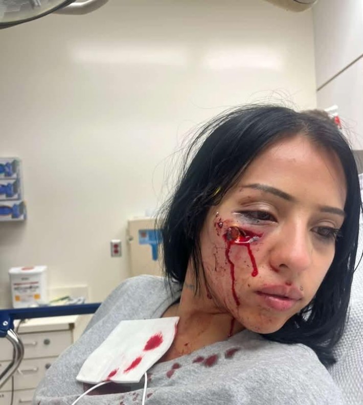 Jasmin Lomas sits in a hospital room with a laceration on her right cheek underneath her eye. Blood drips down her face and onto her shirt.